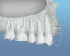 Bone Grafting Seattle, WA - Bone Grafting for Dental Implants | PSOMS