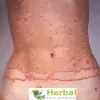 What Is Granuloma Annulare Symptoms, Causes And Treatment - Herbal Care Products