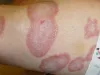 Granuloma Annulare - Auto Immune Skin Disorder - Herbal Care Products