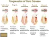 Gum Surgery