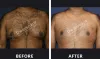Gynecomastia Surgery in Delhi | Male Breast Reduction Surgery