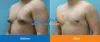 Gynecomastia Surgery in Pune | Male Breast Reduction Surgery in Pune
