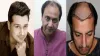 Can I Get Hair Transplant in Pakistan or do I need to go out of the Country