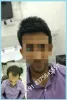 Hair Fixing in Gurgoan | Permanent Hair Fixing in Gurgaon