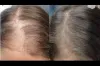 Hair Loss &amp; Nail Disorders Treatment Dubai &amp; Abu Dhabi | Nail Fungal Infection