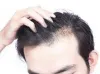 Hair Transplant Clinic in Gurgaon Near Me