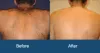 Laser Hair Removal in Delhi, Laser Hair Removal Cost in Delhi, Permanent Laser Hair Removal India | Cosmetic Dermatology India