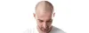 What Everyone Must Know About Hair Replacement | Hair Transplant Dubai