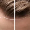 Body Hair Transplant – Opportunities and Considerations - Vuepk Clinic®