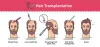 Best Hair Transplant Surgeon - Beyondsmilehairtransplant.com