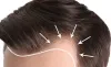Hair Transplant in Delhi | Dr. Lokesh Handa - Med Esthetiks