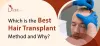 Which is the Best Hair Transplant Method and Why?