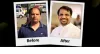   Hair Transplant Cost In Delhi | Dr. A's Clinic
