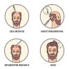 PRP for Hair Loss Treatment in Delhi 