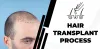 How does the hair transplant process perform?