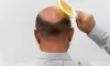 Best Hair Transplant Treatment in Gurgaon