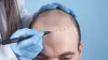 Best Hair Transplant in Delhi