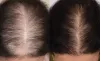 Best Hair Loss Treatment in Gurgaon - AKS Clinic
