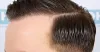 Hair Transplant in Islamabad Pakistan 