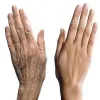 Hand Rejuvenation; dynamicclinic