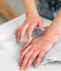 hands-patient-suffering-from-psoriasis.jpg