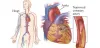 heart bypass surgery hospitals in Delhi