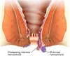 Homeopathy Medicine For Piles | Homeopathy treatment for piles