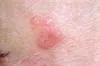 Herbal Treatment for Lichen Planus and Its Promising Solution - Herbal Care Products - Blog