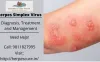 Herpes Simplex Virus- Diagnosis, Treatment, and Management