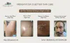 Herpescure get free remedies to treat herpes simplex virus 