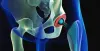Uses of Hip Implants in Treatment of Hip Fractures | Hip Fracture Recovery