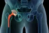 Hip Replacement Treatment with Artificial Implantation