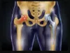 hip_replacement.png