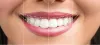 Hollywood Smile in Turkey - From A to Z | Is it Worth It?