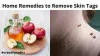 How to Remove Skin Tags: Home Remedies, Cost, Homeopathy