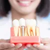 Dental Implant Surgery Houston | Dental Implant Procedure
