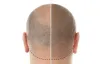 How Baldness Occurs and What Solutions Science Offer? – Top Health Camp