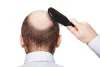 How can Non-Surgical Hair Transplant methods be the go-to option for you? – Exercise and Eating Healthy