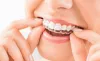 How Does A Dental Aligners Work? 
