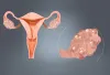 How is polycystic ovary syndrome (PCOS) treated?