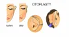 Otoplasty Cost in Delhi
