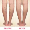 Best Varicose Veins Treatment in Mumbai, India | Best Doctor for Varicose Vein | Dr. Jathin's Vein Center