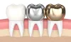 How Long Do Dental Crowns Last?