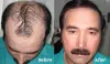 FUE Hair Transplant in Islamabad 