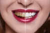 Porcelain Veneers: Five Reasons To Choose Them.  - by veneersdentist - veneersdentist