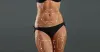 Are Liposuction Surgery Results Permanent?