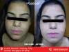 #1 Best Hydra Facial Treatment in Durgapur
