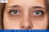 hyperpigmentation around eyes