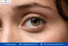 hyperpigmentation under eyes