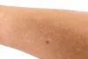 Everything to Know about Idiopathic guttate hypomelanosis